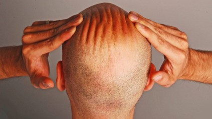 Mann mit Glatze reibt sich den Kopf