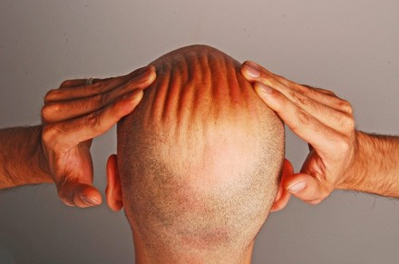 Mann mit Glatze reibt sich den Kopf